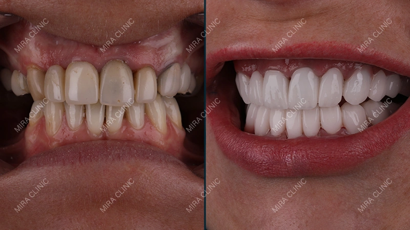 Dental implants Before and After